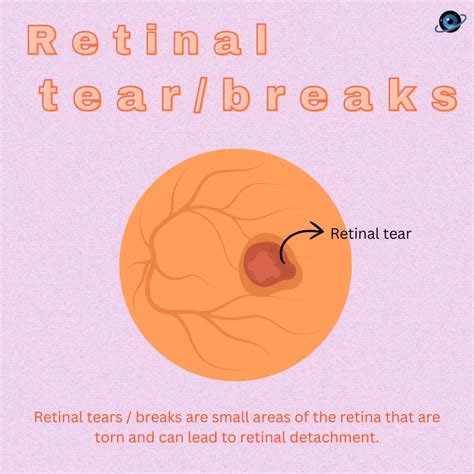 Retinal Tear & Detachment – Symptoms, Risk factors and Prevention | Universal Eye Clinic | Eye ...