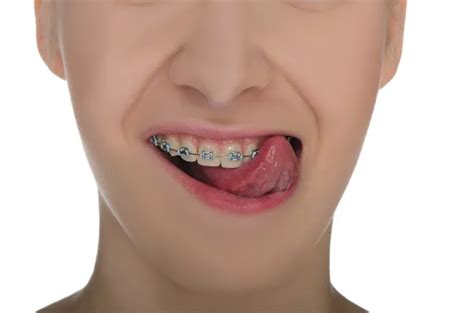 I Got Braces at 60 Years Old, and My Smile’s Never Looked Better HD Wallpaper