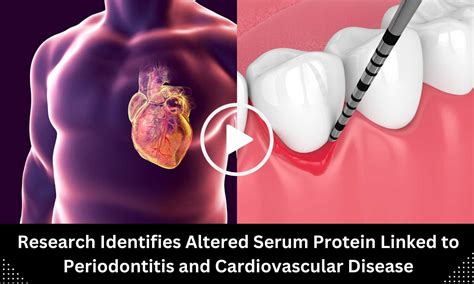 Research Identifies Altered Serum Protein Linked to Periodontitis and ...