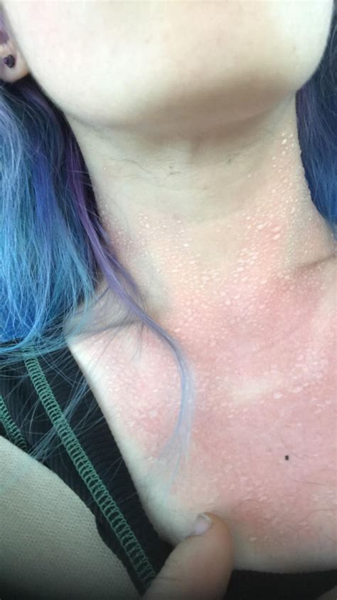 Sweat blisters from sweating after a sunburn : r/popping