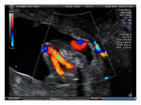 Bildergebnis für 2 vessel umbilical cord ultrasound