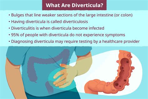 Do Nuts And Seeds Cause Diverticulitis at Alonzo Caraway blog