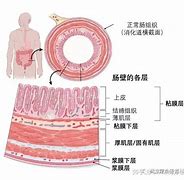 Image result for 结肠癌