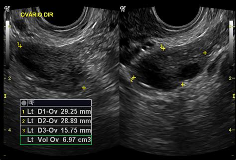 Pathology of the Ovaries - Clinical Tree