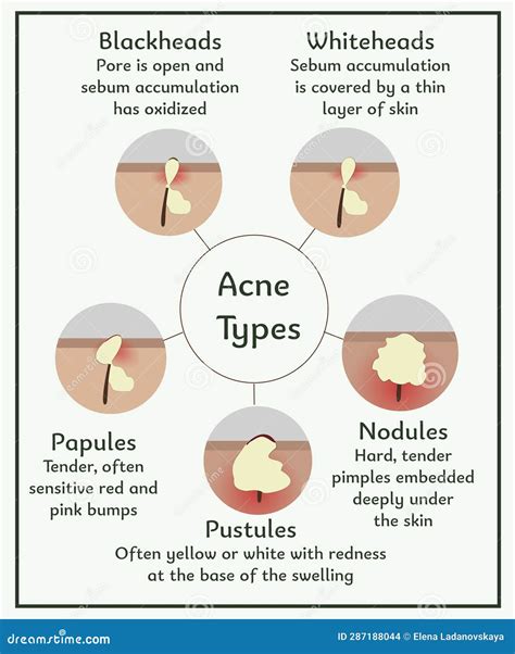 Acne Types. Medical Illustration Stock Vector - Illustration of comedo, blackhead: 287188044