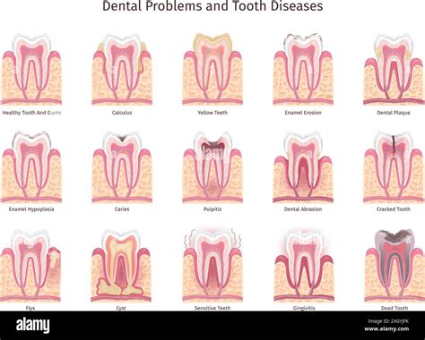 Teeth problems infographic. Human tooth decay, oral cavity problem dentist brochure sensitive ...
