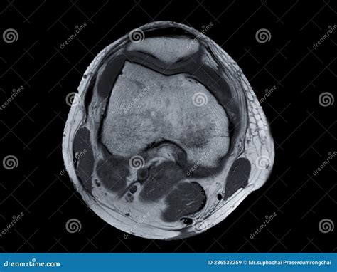 Magnetic Resonance Imaging or MRI of Knee Joint Axial View for Detect Tear or Sprain of the ...