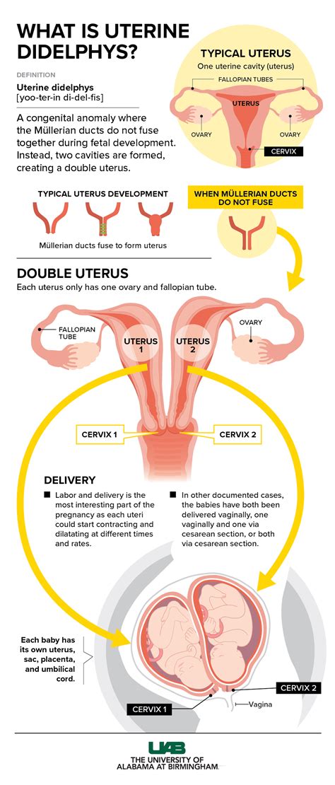 Didelphic Uterus Pictures