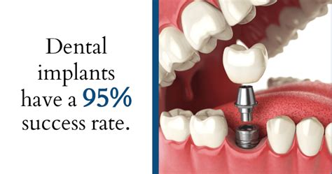 Dental Implant Success Rate - Problems with dental implants