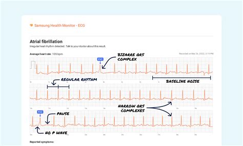 Premature Ventricular Contractions Couplet