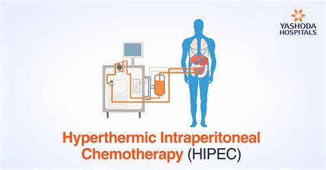 Image result for HIPEC Surgery