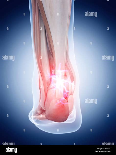 medical 3d illustration of a painful achilles tendon Stock Photo - Alamy
