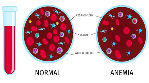 Sickle Cell Anemia Symptoms: सरकार का 2047 तक देश से सिकल सेल एनीमिया ...