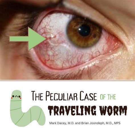 The Peculiar Case of the Traveling Worm | Colorado Retina Associates
