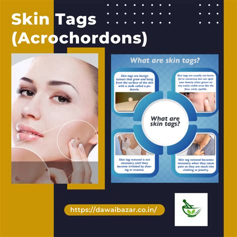 Understanding Skin Tags: Causes, Treatment, and Prevention Tips ...