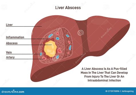 Liver Abscess. Human Internal Organ Tissue Inflammation and Pus ...
