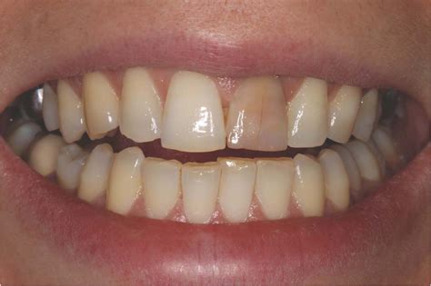 Image result for Discolored Tooth