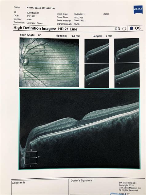 Image result for How to Use the Oct Scan in Optometry