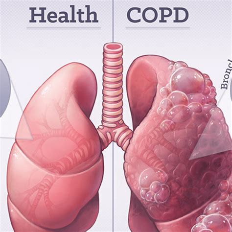Image result for SpO2 and COPD