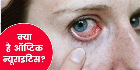 Optic neuritis causes symptoms treatment in hindi | क्या है ऑप्टिक ...