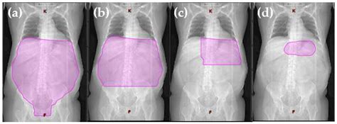 Development of Organ-Preserving Radiation Therapy in Gastric Marginal ...