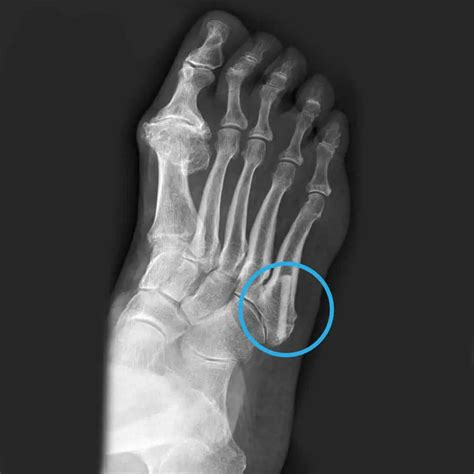 Metatarsal Bone Fracture