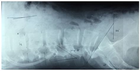Straight Leg Raise Test: Influence of Lumbosant© and Assistant Examiner ...