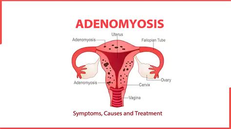 What Are Symptoms Of Adenomyosis