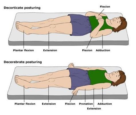 Image result for Decorticate Posture