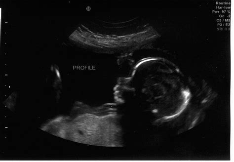 Image result for Alien Baby Ultrasound Scene