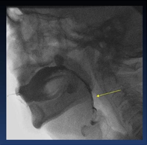 Figure 48 from Conventional radiology in the study of dysphagia. The ...