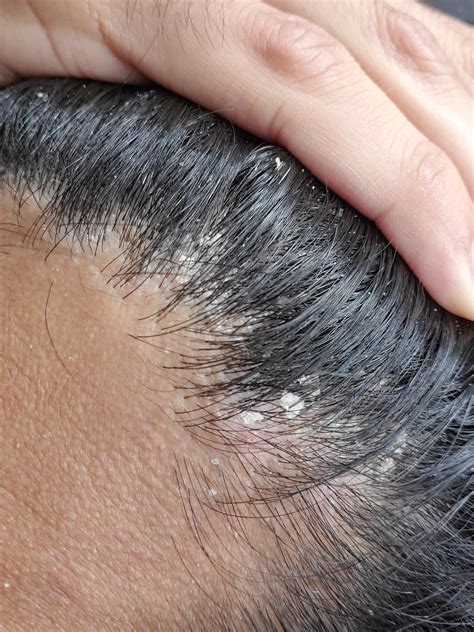 Dandruff Or Dry Scalp