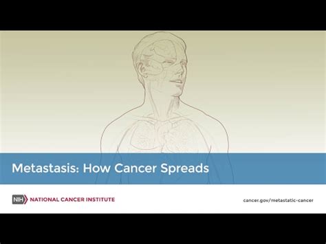 Definition of metastasize - NCI Dictionary of Cancer Terms - NCI