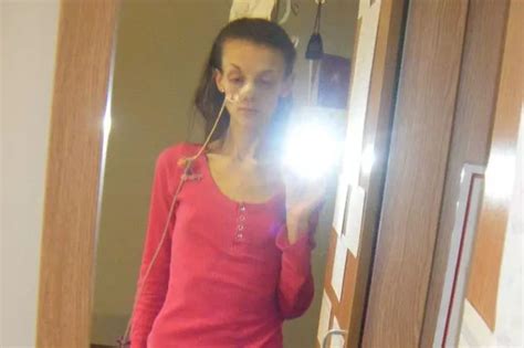 Shocking pictures of anorexic who did 50,000 sit-ups a day and ate ...