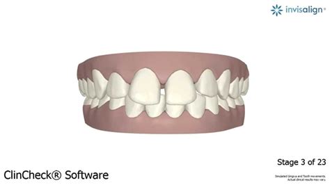 Image result for Invisalign ClinCheck