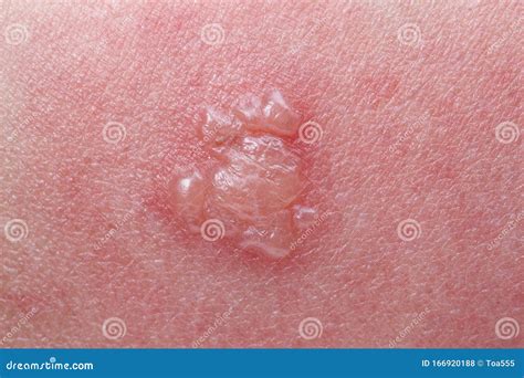 Shingles, Zoster or Herpes Zoster Symptoms on Arm Stock Photo - Image of hospital, care: 166920188