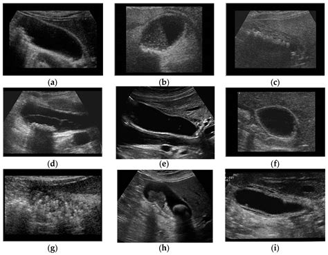 Diseased Gallbladder Ultrasound
