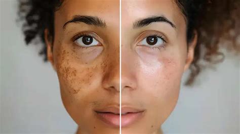 Are you troubled by pigmentation? Then these tips suggested by experts ...