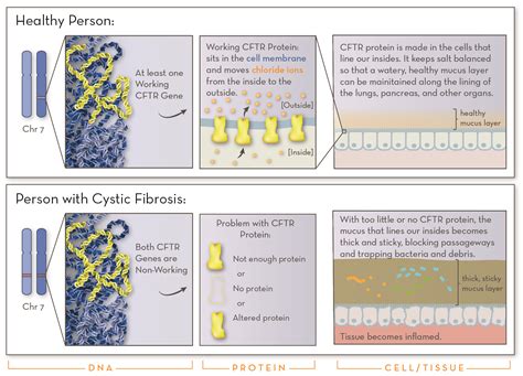 Cystic Fibrosis