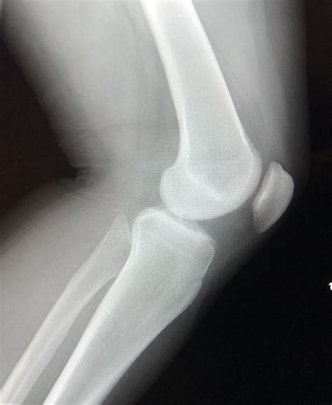 Lateral Knee Xray