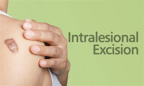 Keloid Care in Surat | Dr. Ashutosh Shah