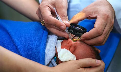 Nailfold capillaroscopy noninvasive method for early detection of ...