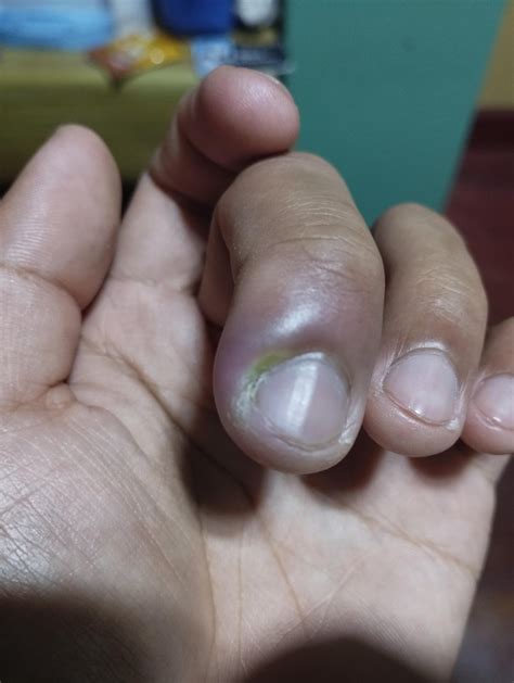 Any home remedies for paronychia : r/medical_advice