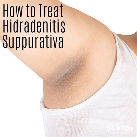 How Do You Get Hidradenitis Suppurativa - SMARTCUSTOMESSAYS.COM