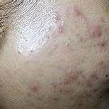 La Roche-Posay Anthelios 60 Ultra Light Sunscreen Fluid For Face, 1.7 ...