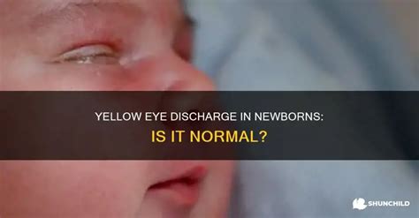 Yellow Eye Discharge In Newborns: Is It Normal? | ShunChild