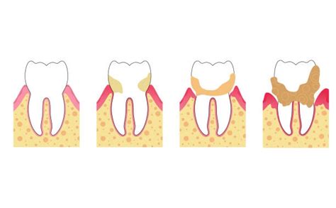 Image result for Tooth Calculus