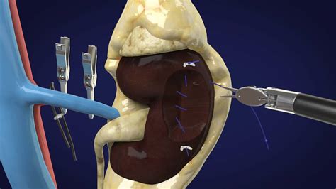 Image result for Nephrectomy Positioning