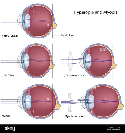 Correction Of Myopia