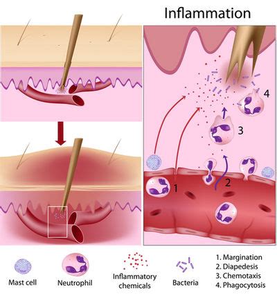 Inflammation Process Steps 的图像结果